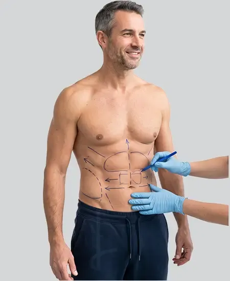 Abdômen masculino com marcação cirúrgica para Lipo HD, indicando as áreas de definição muscular